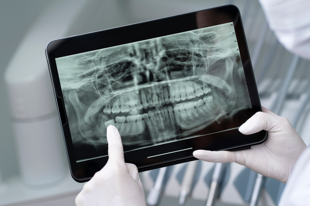 Digital X-ray